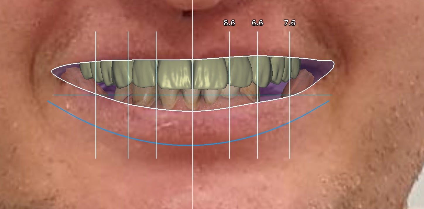 Smile-Design-Analyse mit Hilfslinien für Mittellinie und Lachlinie