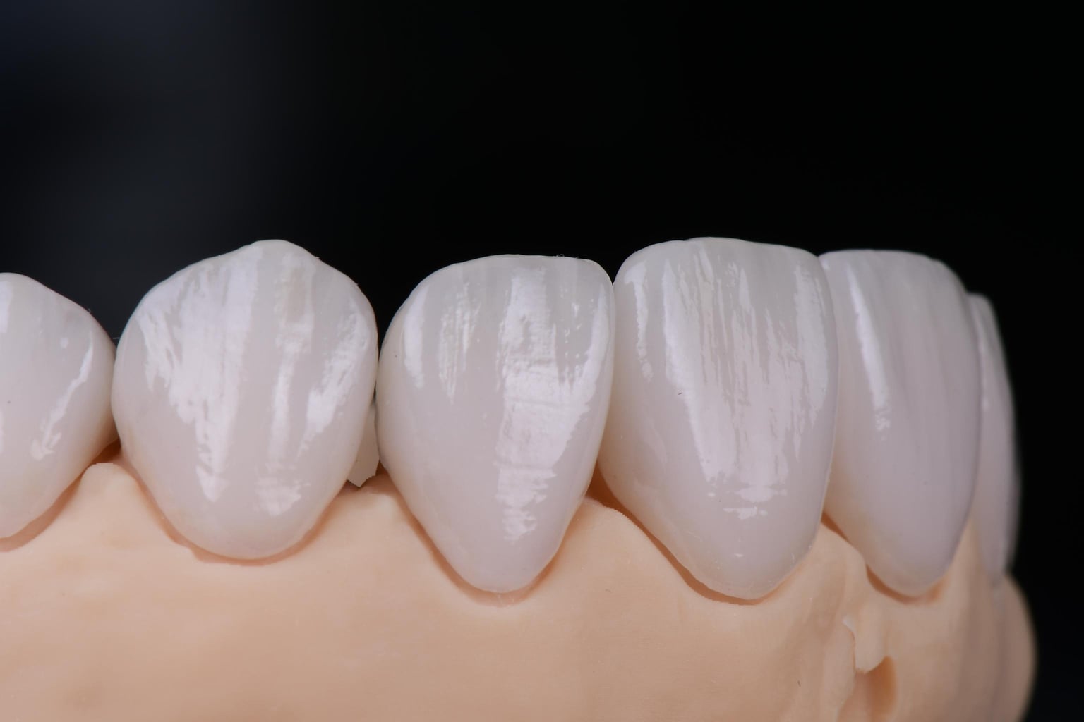 Vollkeramikbrücke mit natürlicher Ästhetik