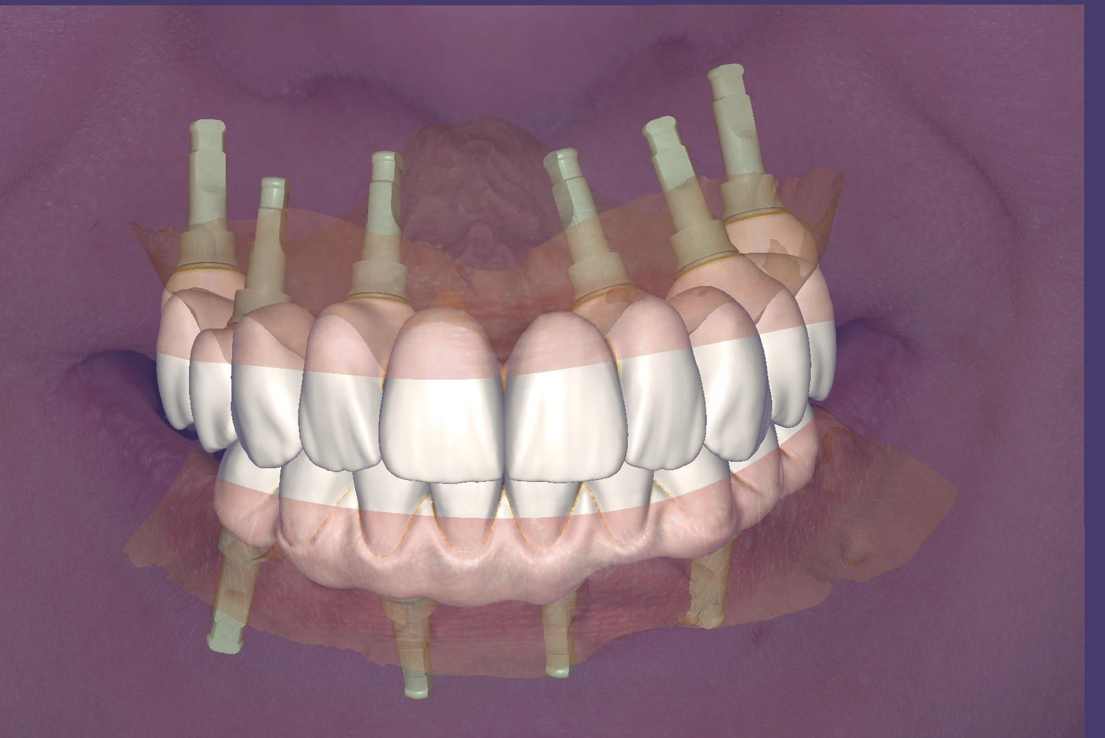 CAD-Konstruktion eines vollständigen Zahnbogens auf Implantaten