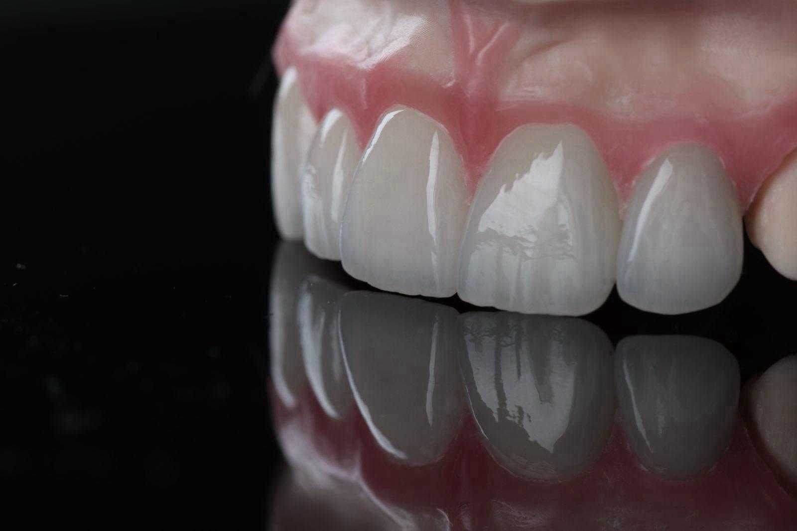 Veneers