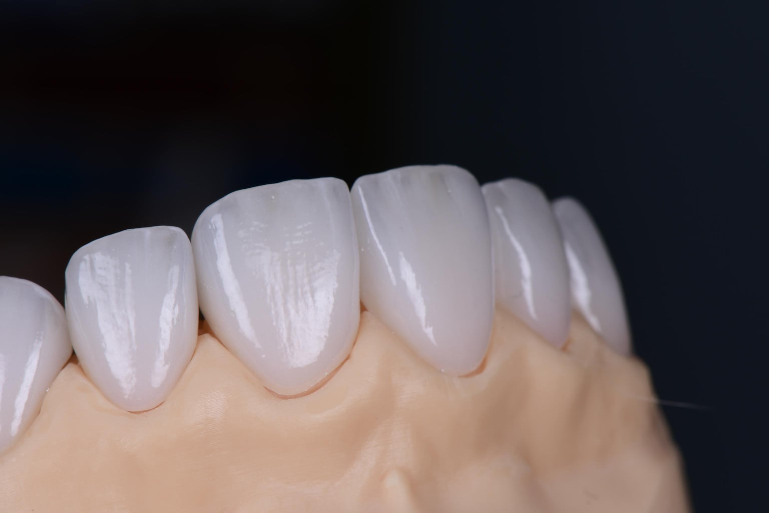 Veneers im Frontzahnbereich, Nahaufnahme auf dem Modell