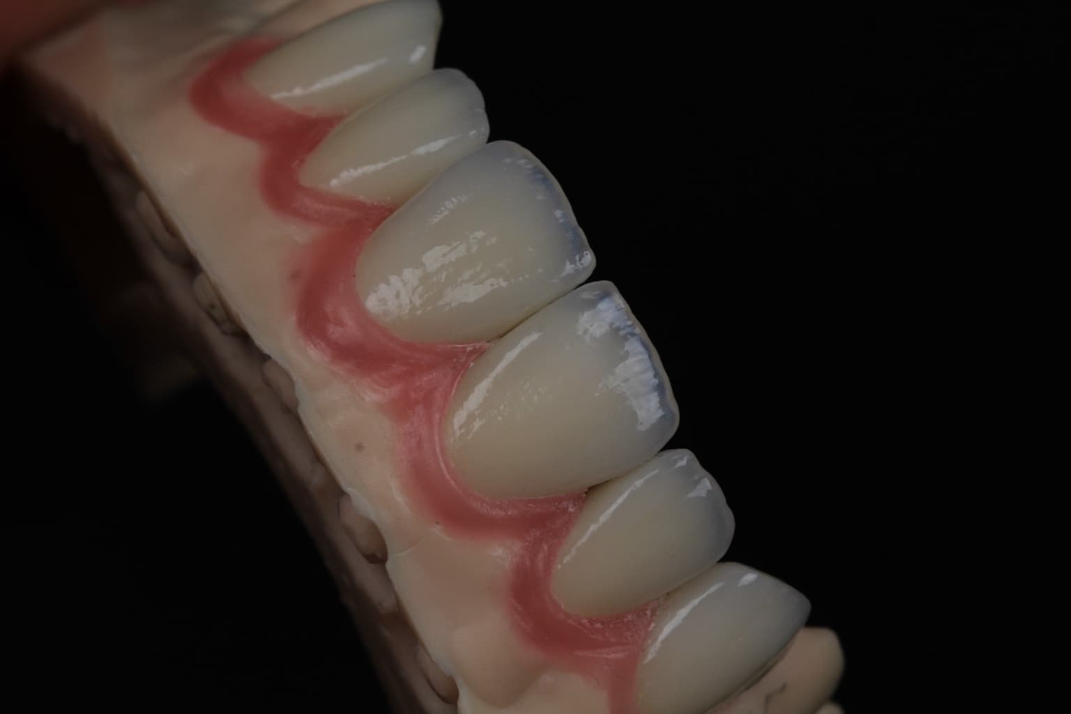 Veneers auf dem Modell, seitliche Nahaufnahme